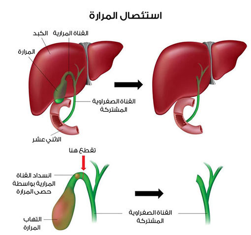 اسباب و اعراض التهاب المرارة